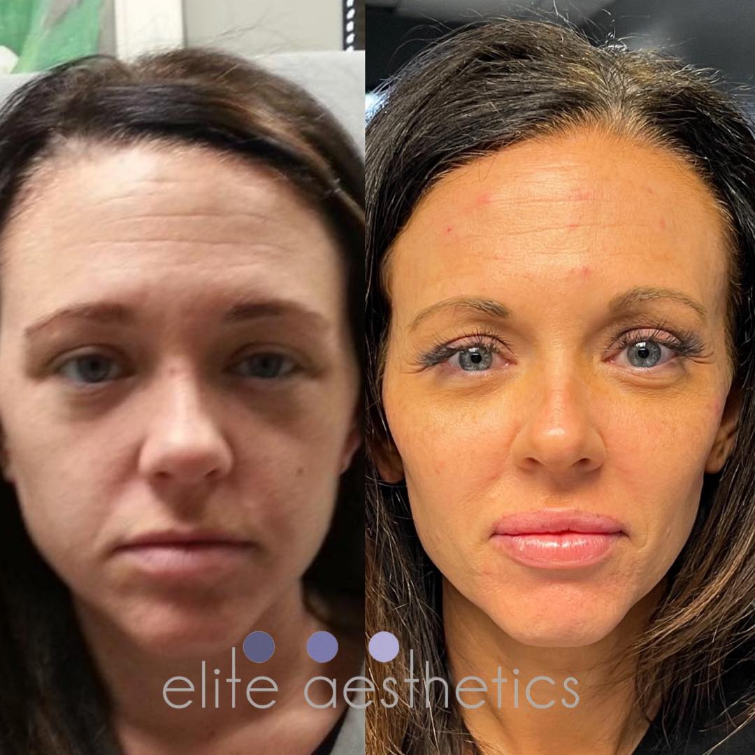 Filler Overland Park Kansas